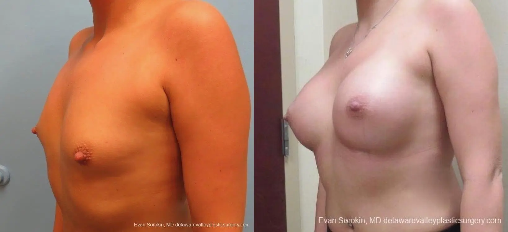 Philadelphia Breast Augmentation 8826 - Before and After 3