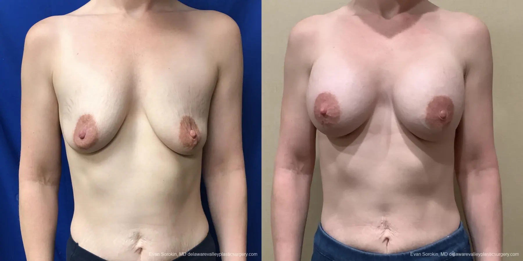 Breast Augmentation: Patient 188 - Before and After 1