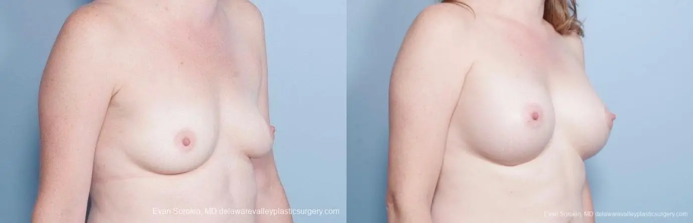 Philadelphia Breast Augmentation 8795 - Before and After 2