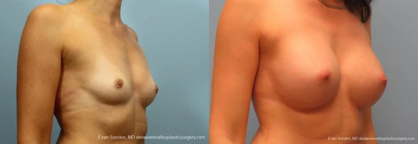 Philadelphia Breast Augmentation 8764 - Before and After 2