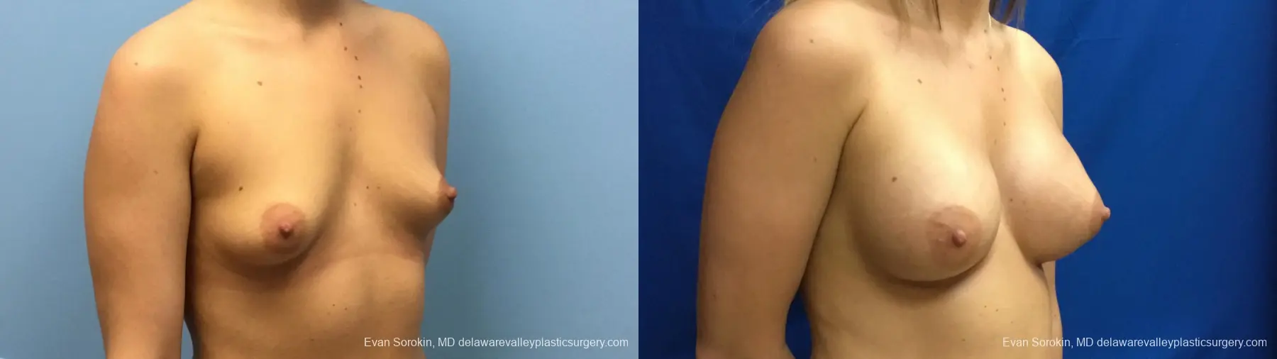 Philadelphia Breast Augmentation 12540 - Before and After 2