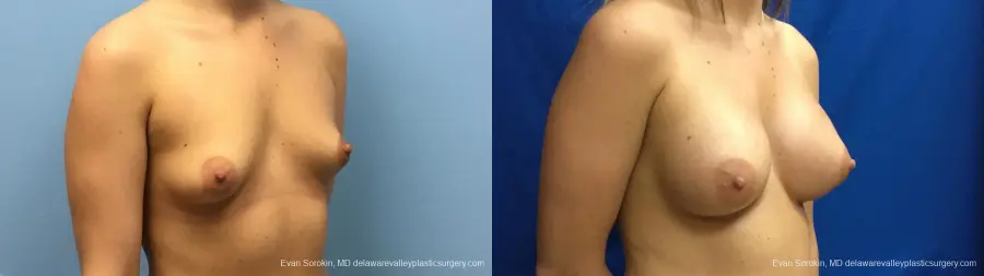 Philadelphia Breast Augmentation 12540 - Before and After 2