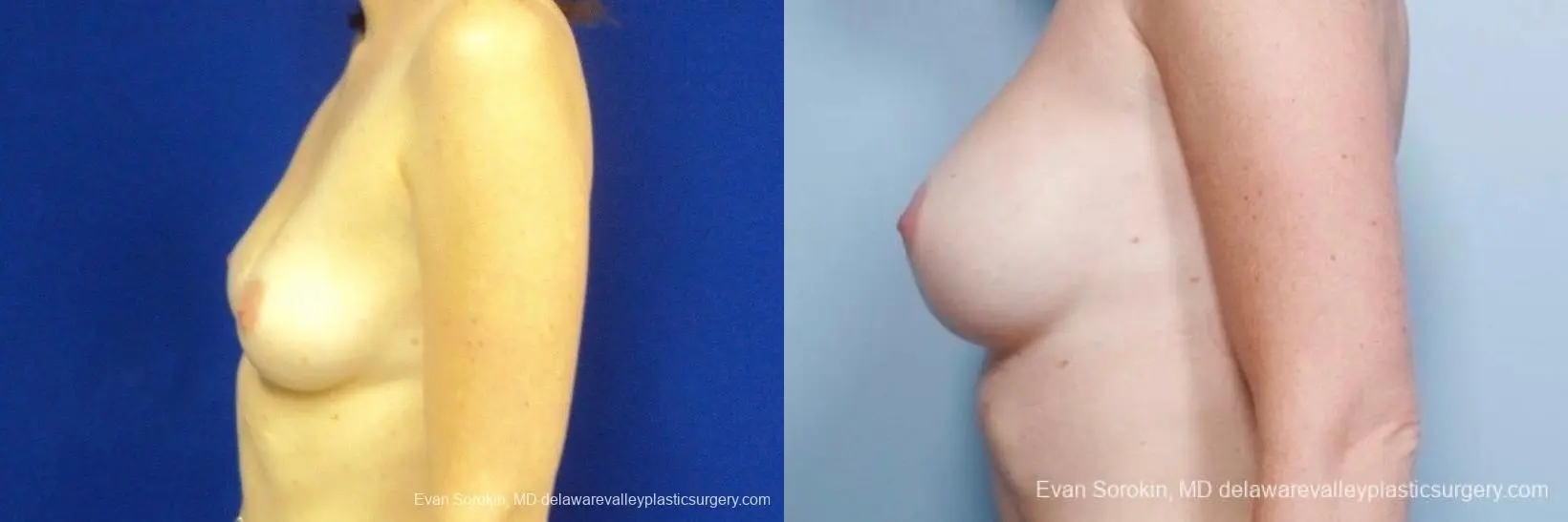 Philadelphia Breast Augmentation 8776 - Before and After 5