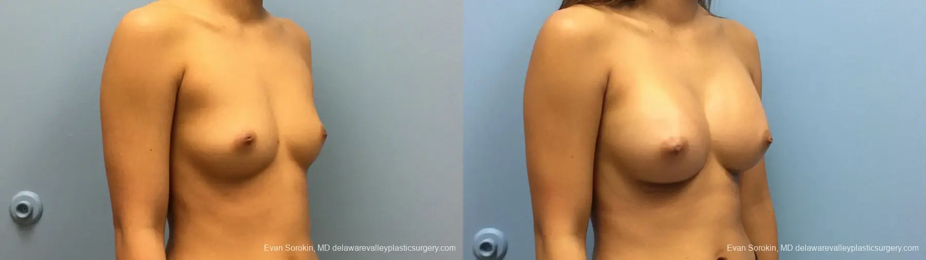 Philadelphia Breast Augmentation 13183 - Before and After 2