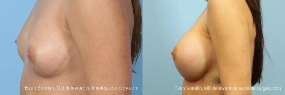 Philadelphia Breast Augmentation 8657 - Before and After 5
