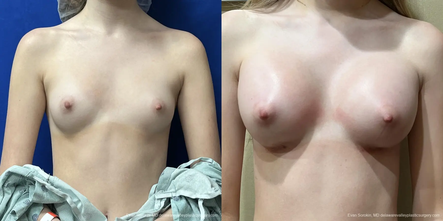 Breast Augmentation: Patient 246 - Before and After 1