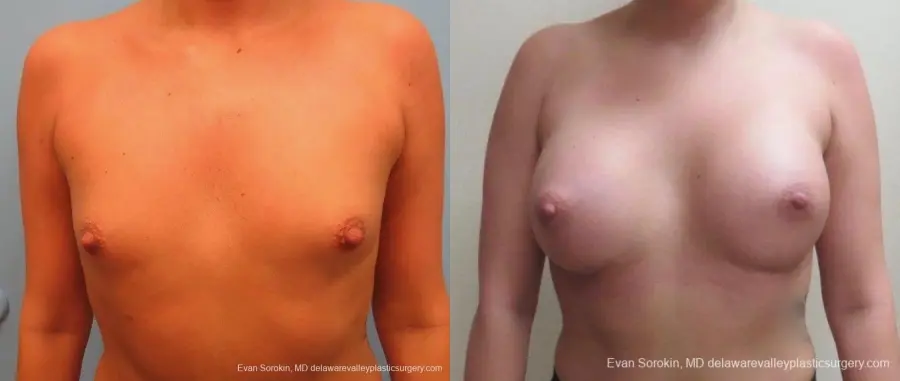 Philadelphia Breast Augmentation 8826 - Before and After 1