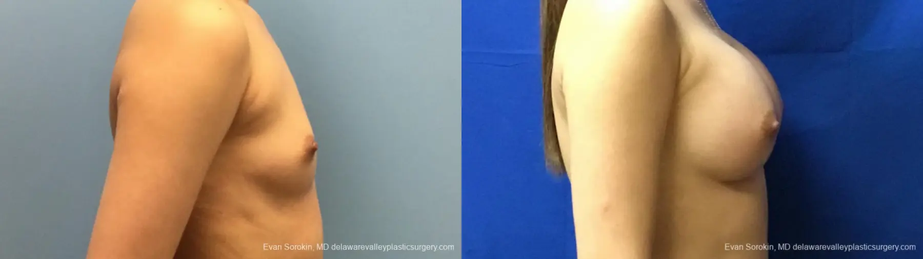 Philadelphia Breast Augmentation 13172 - Before and After 3