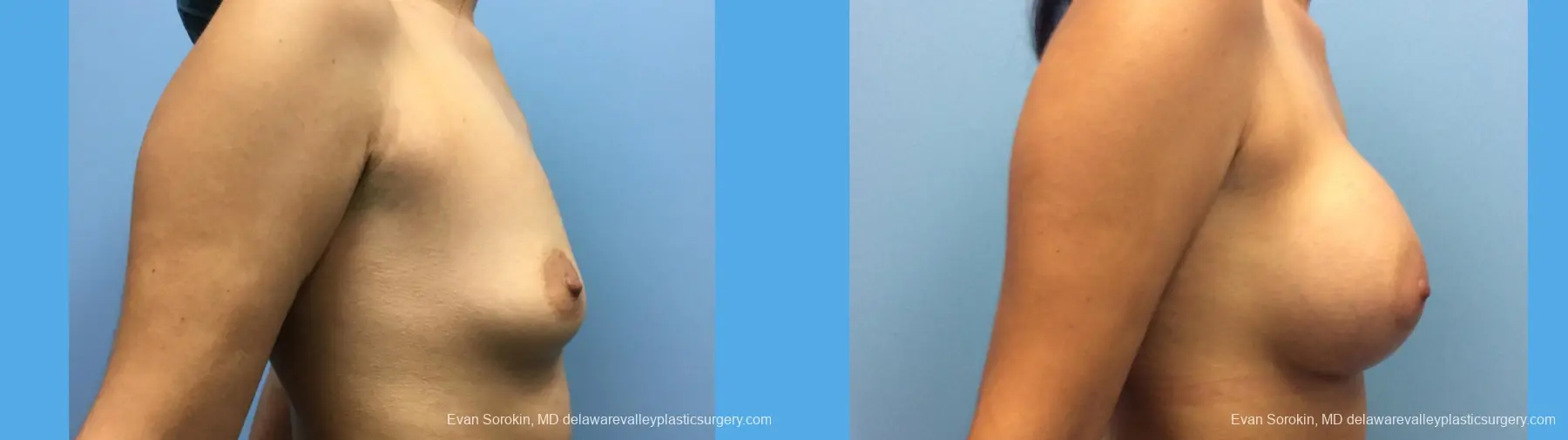 Breast Augmentation: Patient 138 - Before and After 5