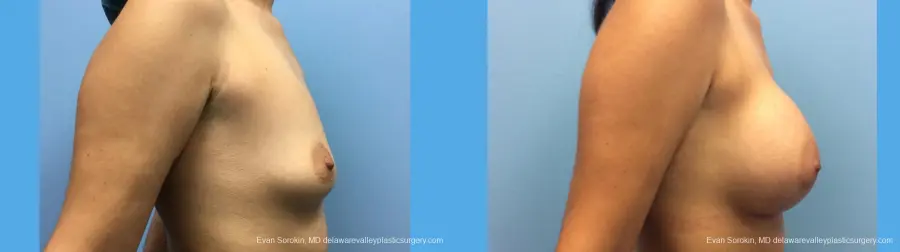 Breast Augmentation: Patient 155 - Before and After 5