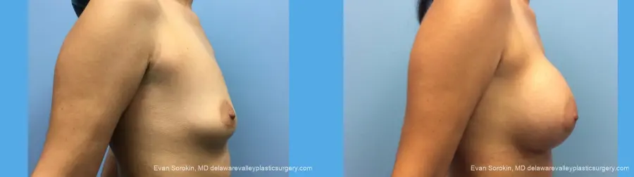 Breast Augmentation: Patient 137 - Before and After 5