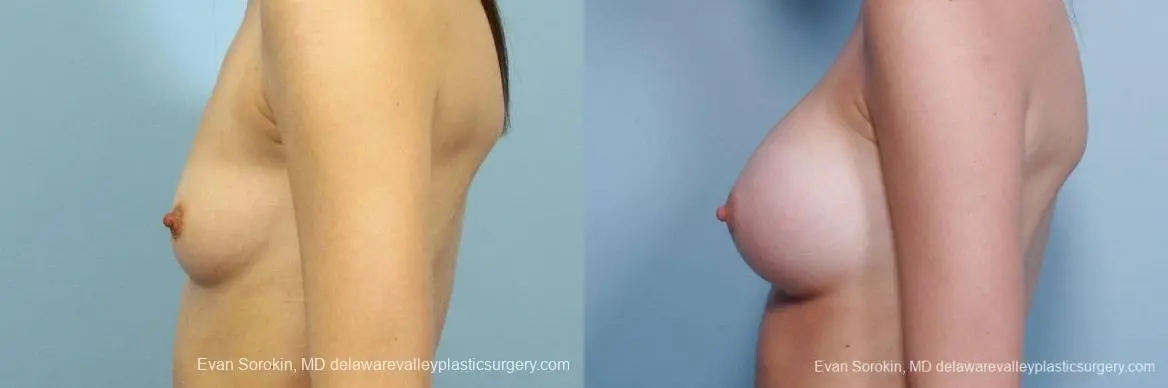 Philadelphia Breast Augmentation 8660 - Before and After 5