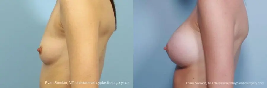 Philadelphia Breast Augmentation 8660 - Before and After 5