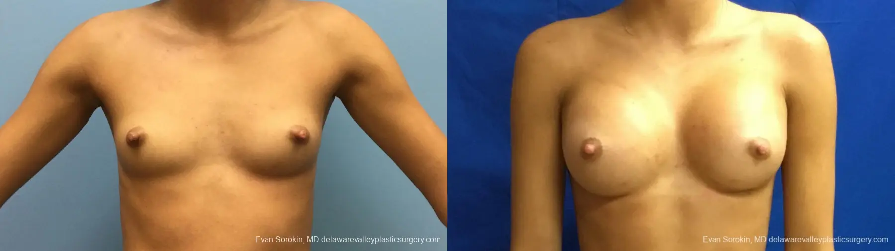 Philadelphia Breast Augmentation 13176 - Before and After 1