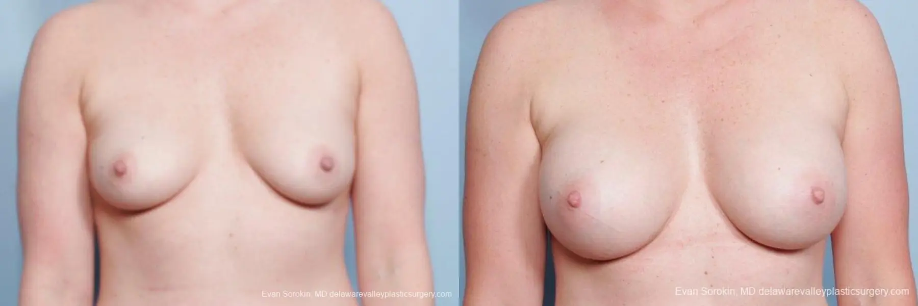 Philadelphia Breast Augmentation 8658 - Before and After 1