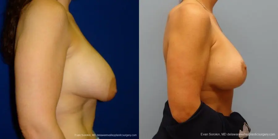 Philadelphia Breast Augmentation 8695 - Before and After 4