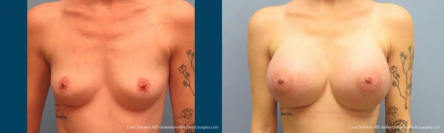 Philadelphia Breast Augmentation 9371 - Before and After 1