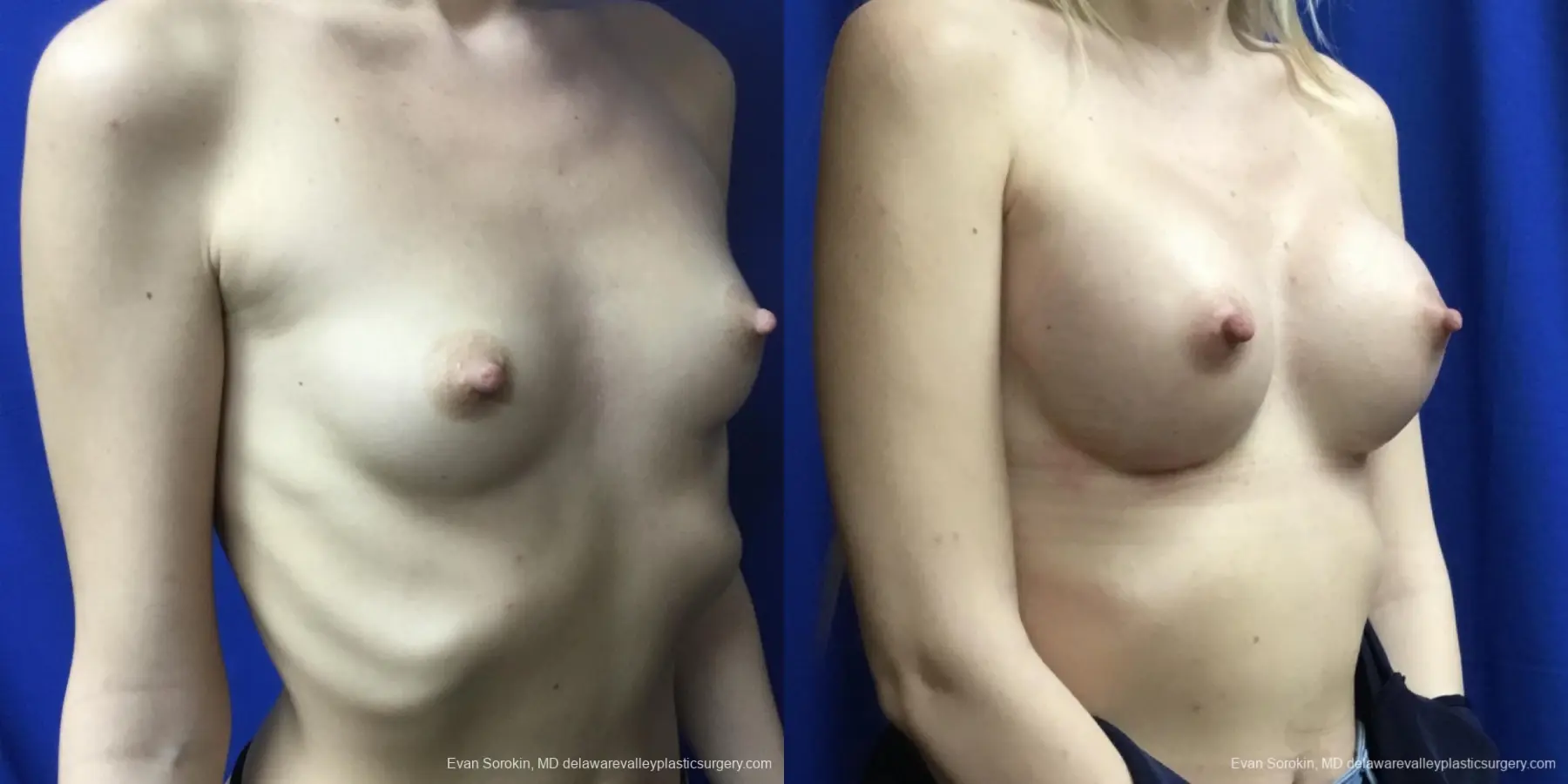 Breast Augmentation: Patient 192 - Before and After 2
