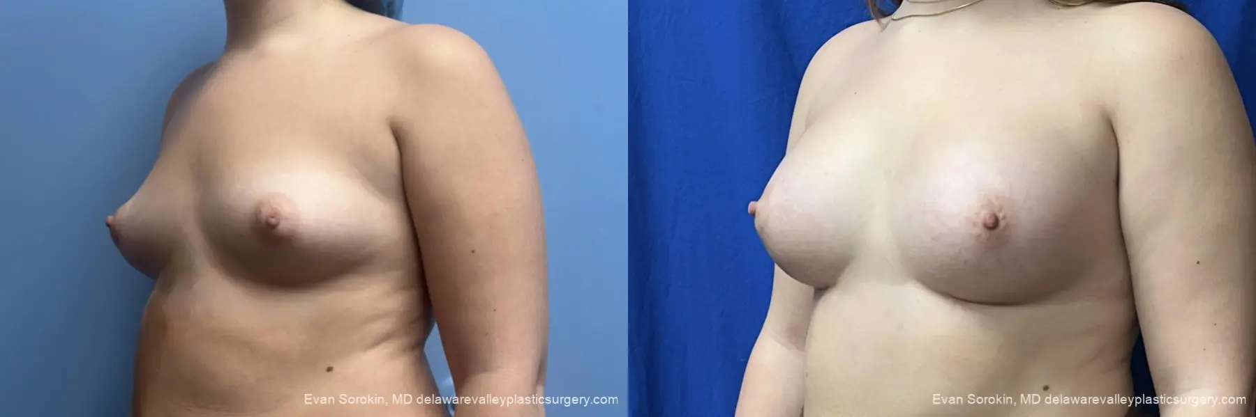 Breast Augmentation: Patient 340 - Before and After 4