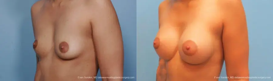 Philadelphia Breast Augmentation 9382 - Before and After 2