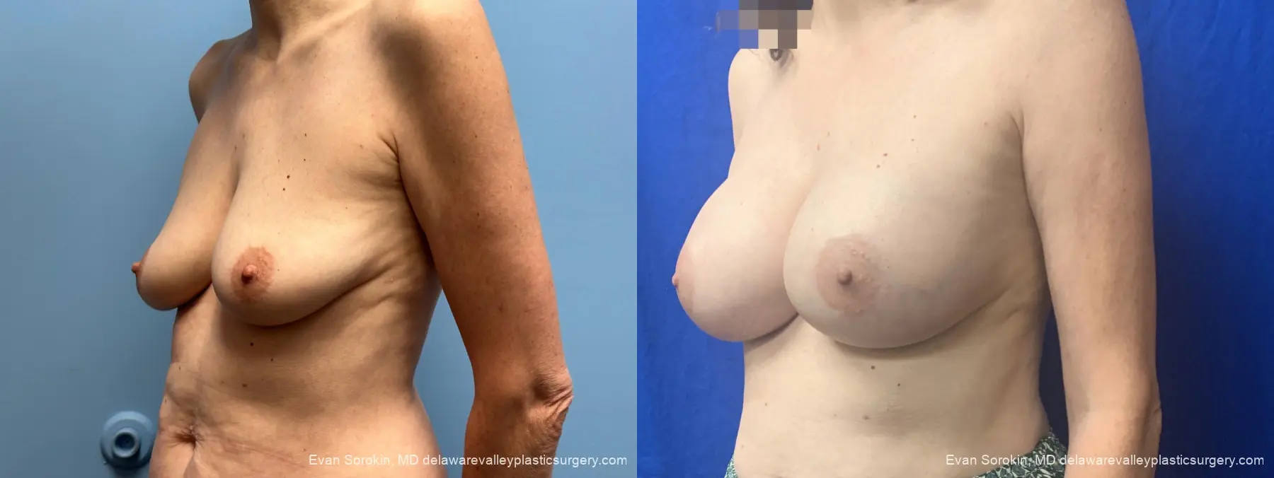 Breast Augmentation: Patient 328 - Before and After 4