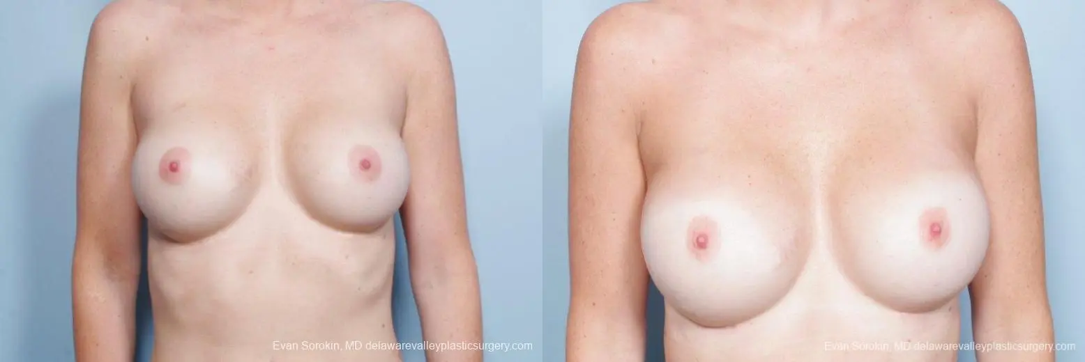Philadelphia Breast Augmentation 9402 - Before and After 1