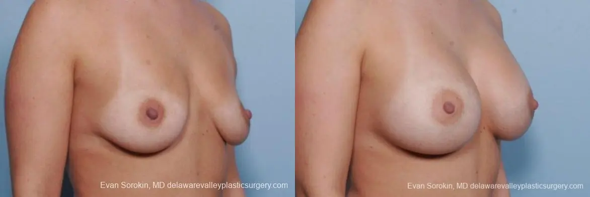 Philadelphia Breast Augmentation 9414 - Before and After 2