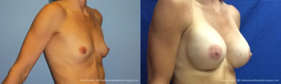 Philadelphia Breast Augmentation 10248 - Before and After 2