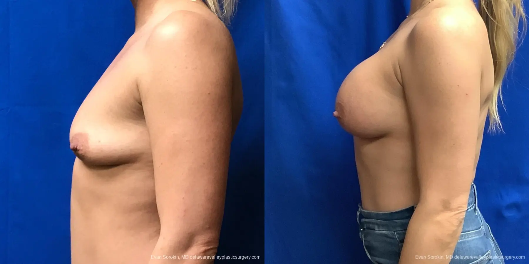 Breast Augmentation: Patient 228 - Before and After 5