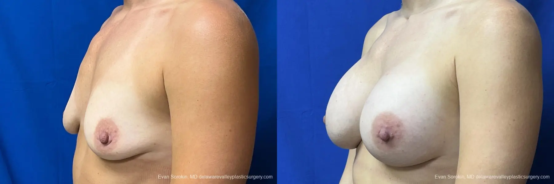 Breast Augmentation: Patient 203 - Before and After 4