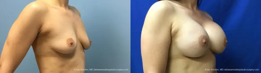 Philadelphia Breast Augmentation 12541 - Before and After 2