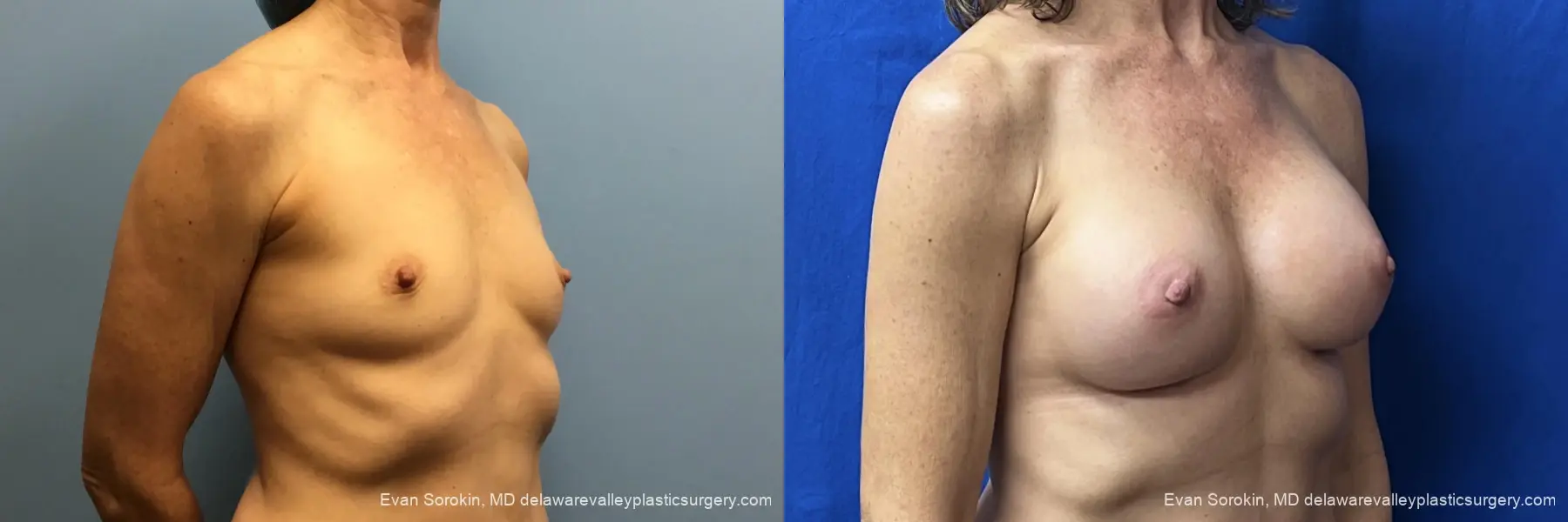 Breast Augmentation: Patient 6 - Before and After 2