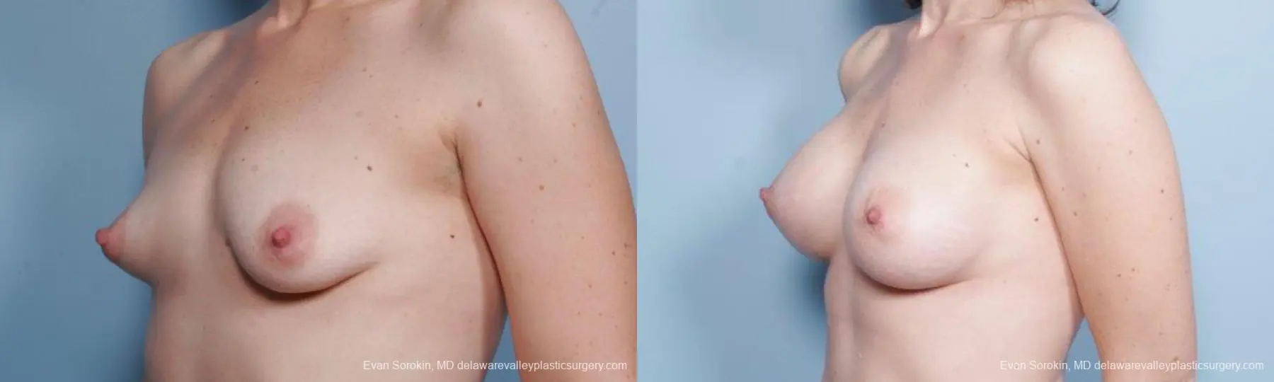 Philadelphia Breast Augmentation 9302 - Before and After 4