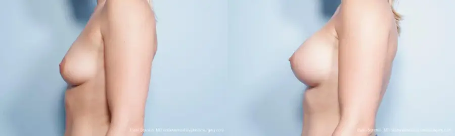 Philadelphia Breast Augmentation 9296 - Before and After 5