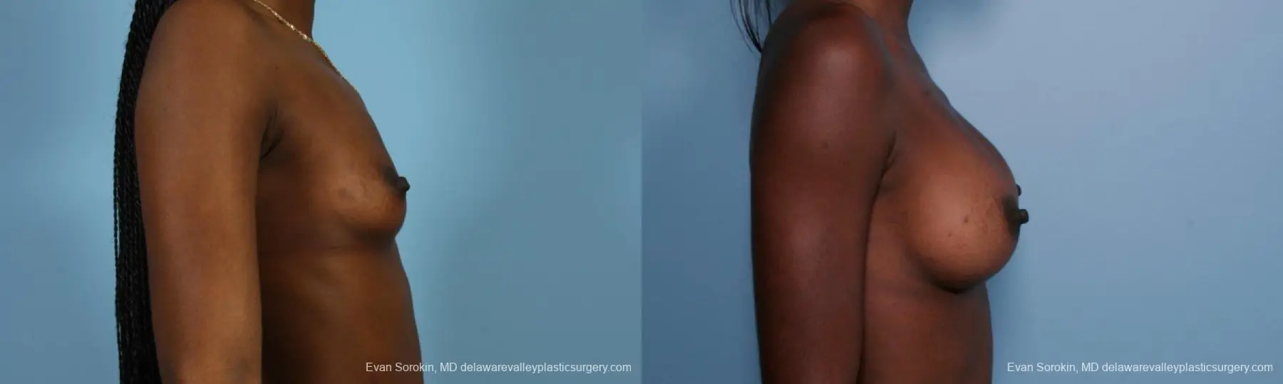 Philadelphia Breast Augmentation 8655 - Before and After 3