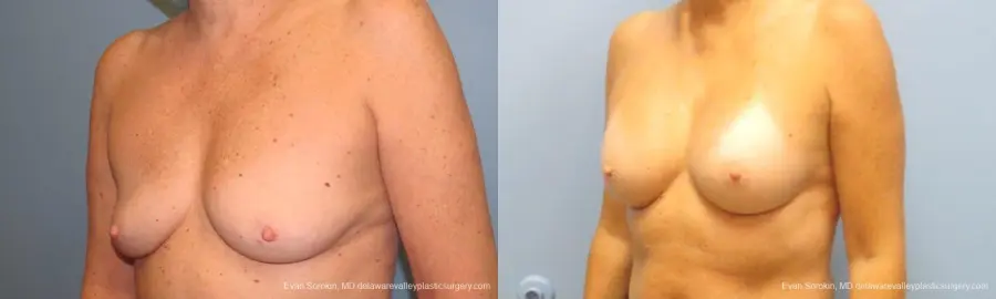 Philadelphia Breast Augmentation 9549 - Before and After 4