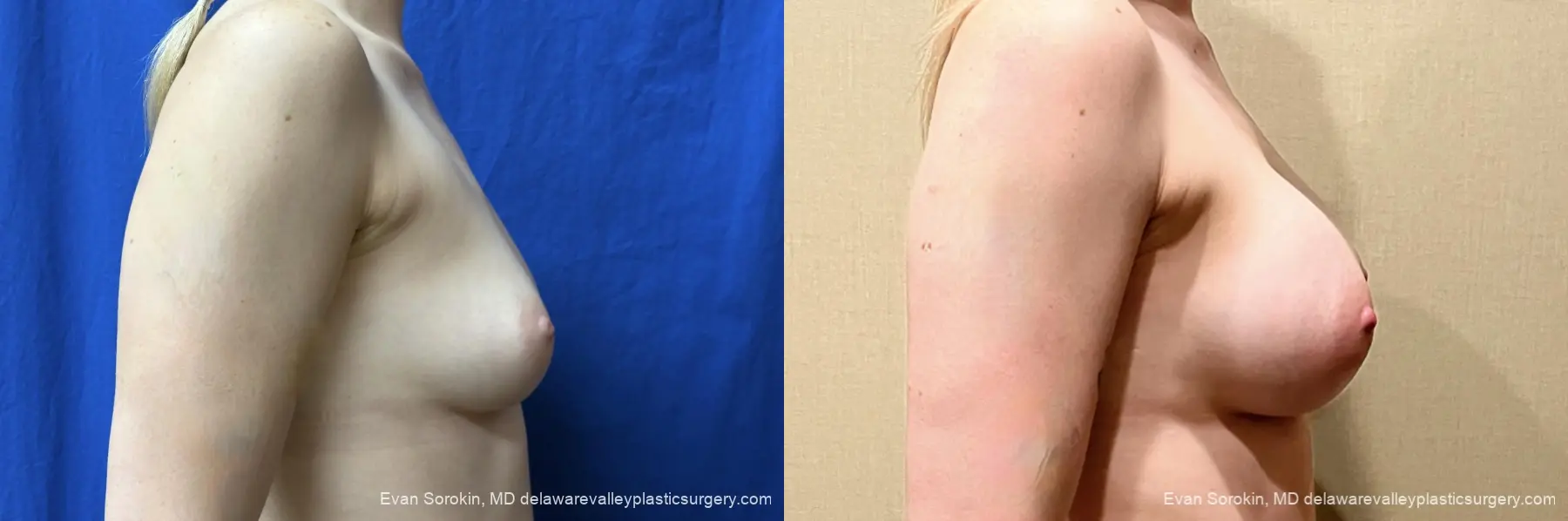Breast Augmentation: Patient 338 - Before and After 3
