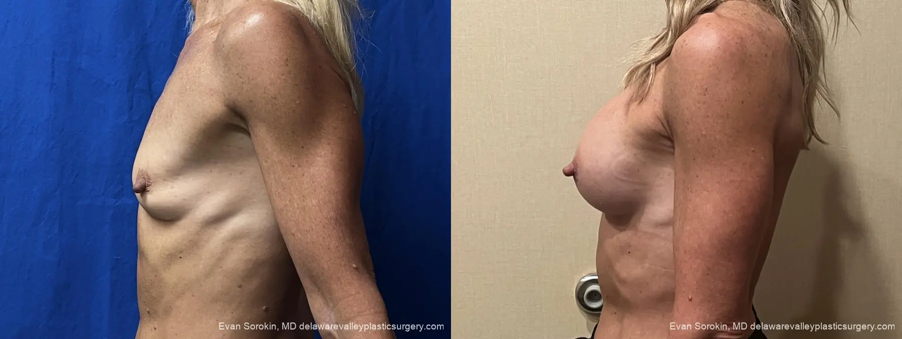 Breast Augmentation: Patient 319 - Before and After 5