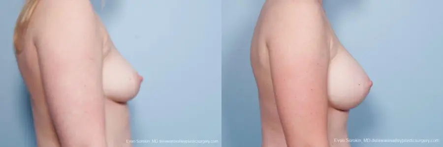 Philadelphia Breast Augmentation 8658 - Before and After 3