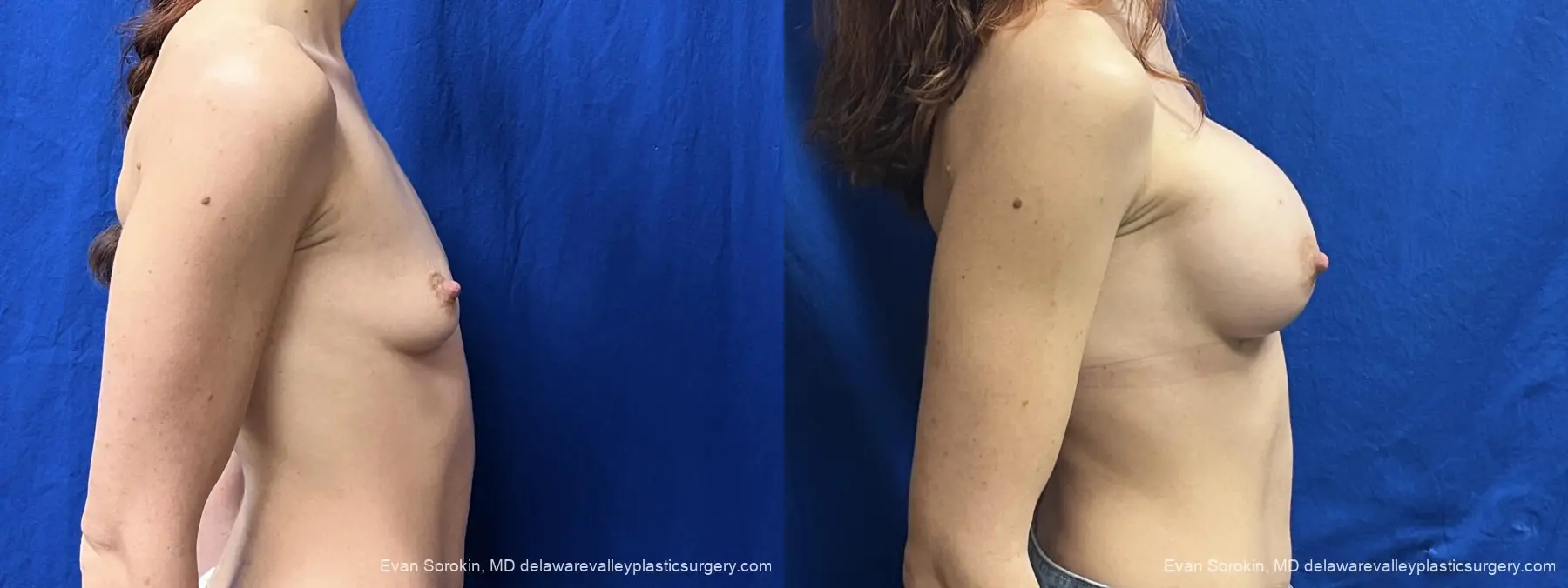Breast Augmentation: Patient 307 - Before and After 3