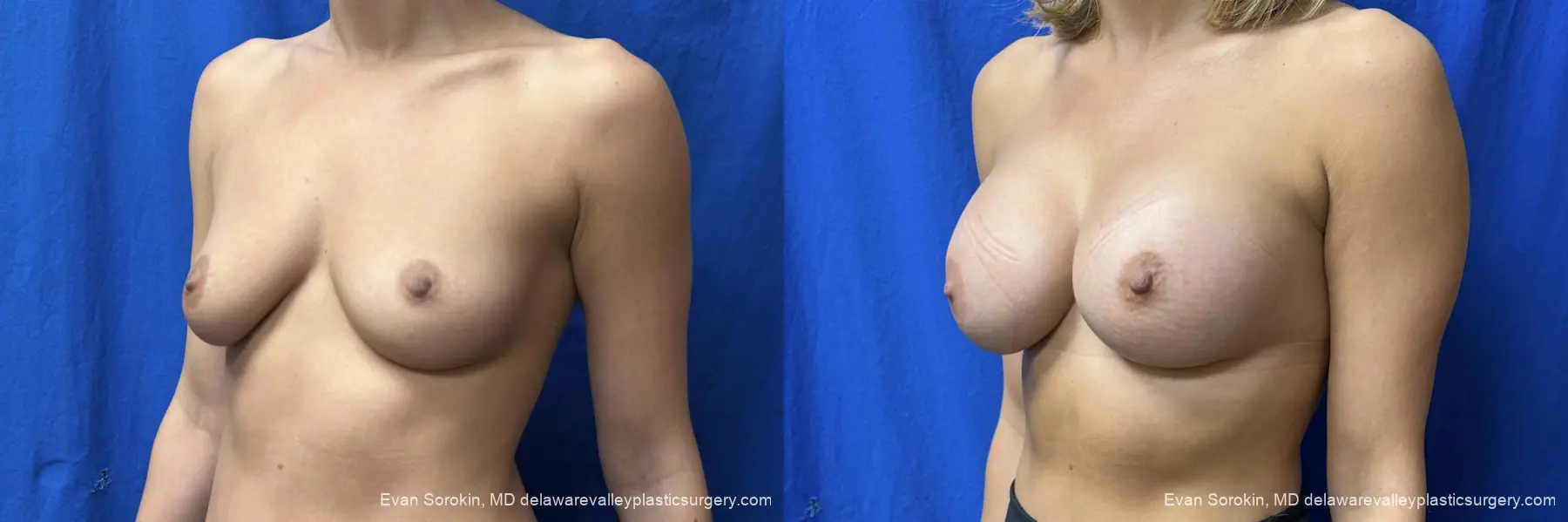 Breast Augmentation: Patient 341 - Before and After 4