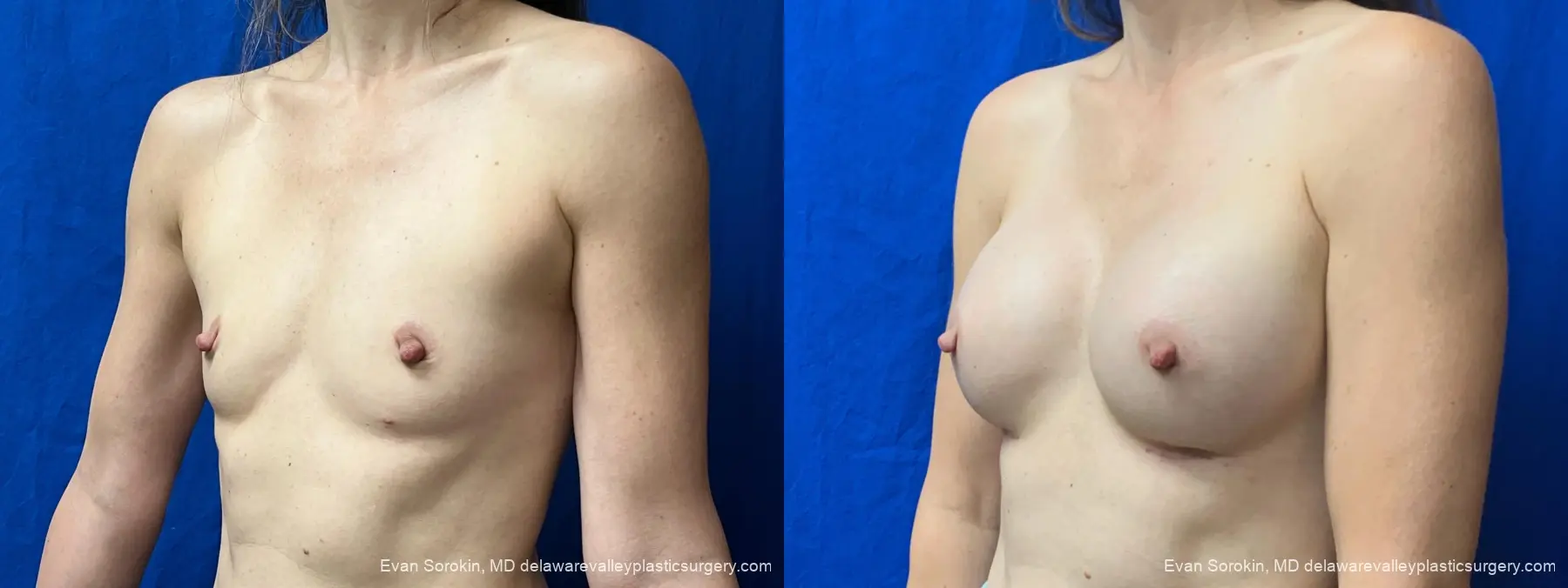 Breast Augmentation: Patient 325 - Before and After 4
