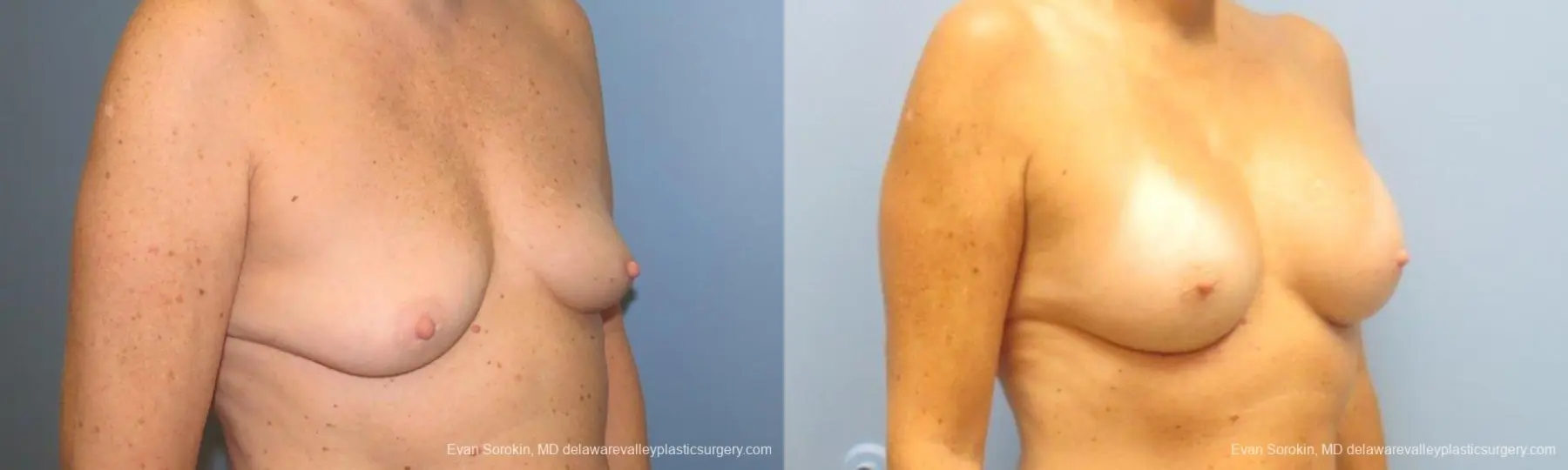 Philadelphia Breast Augmentation 9549 - Before and After 2