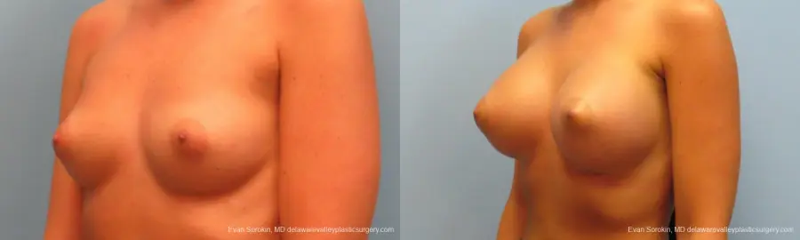 Breast Augmentation: Patient 11 - Before and After 4