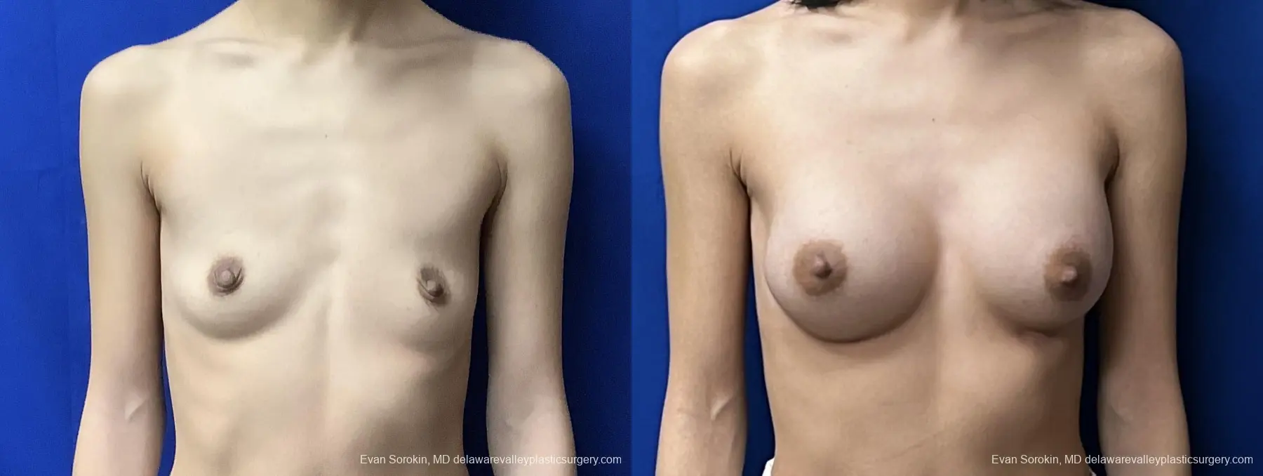 Breast Augmentation: Patient 240 - Before and After 1