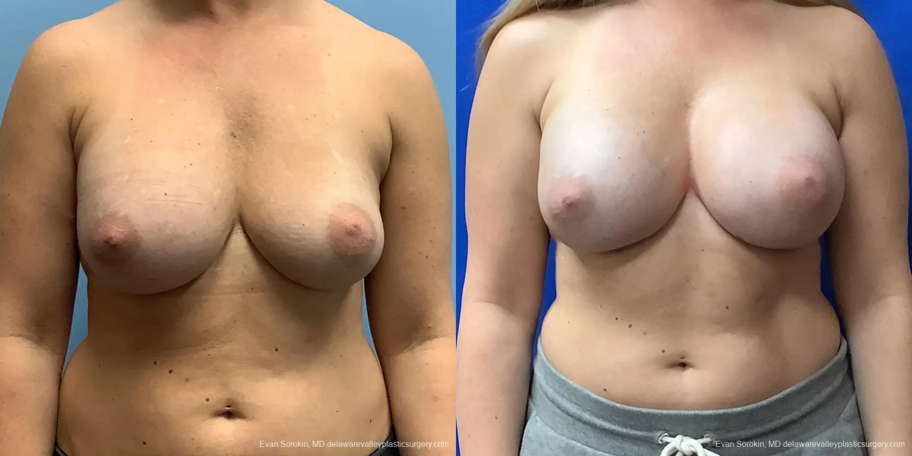 Breast Augmentation: Patient 225 - Before and After 1