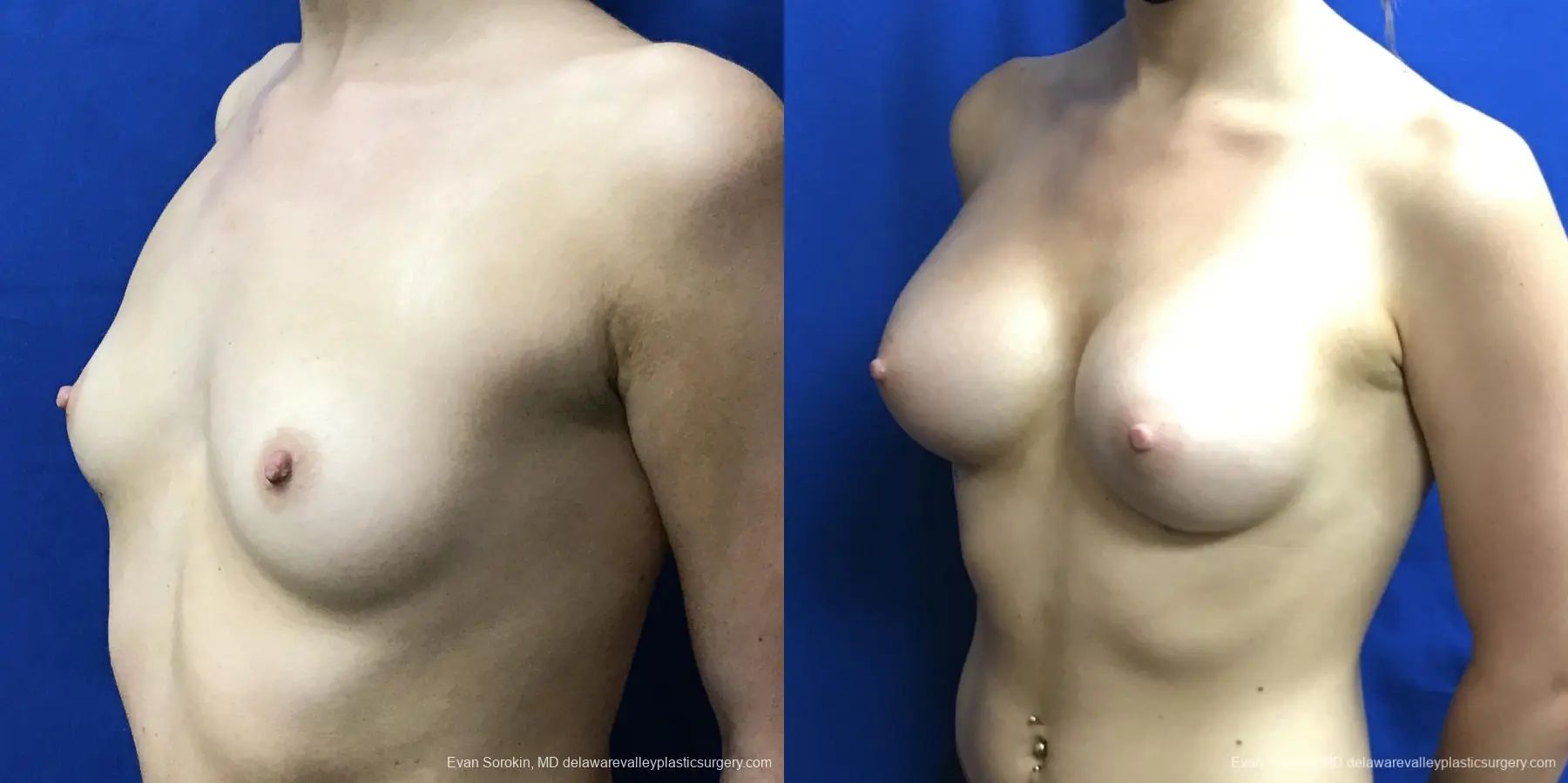 Breast Augmentation: Patient 196 - Before and After 3