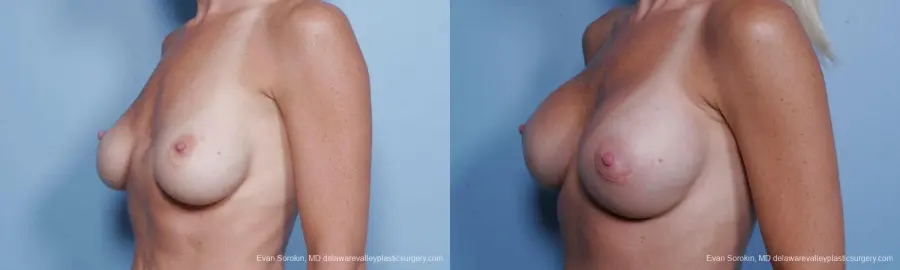 Philadelphia Breast Augmentation 9454 - Before and After 4