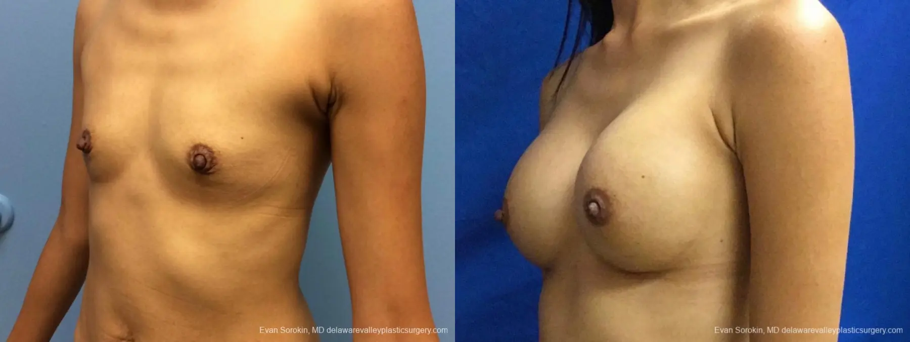 Philadelphia Breast Augmentation 13071 - Before and After 3