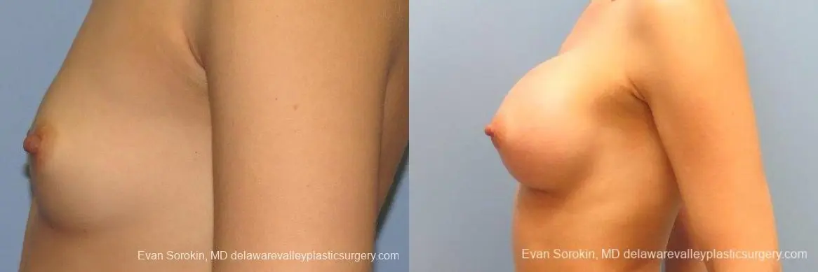 Philadelphia Breast Augmentation 10097 - Before and After 5